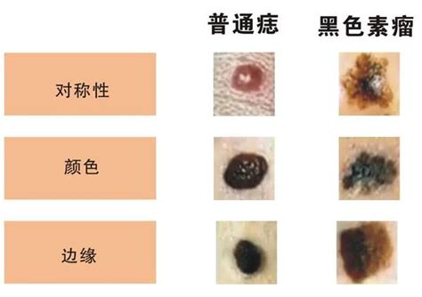 陰囊 痣|陰囊長痣：就診科室與皮膚問題辨識